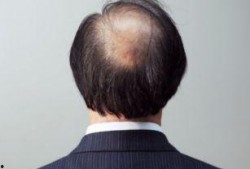 吃瓜吃多了会掉头发吗,揭秘日常饮食习惯与头发健康的关系